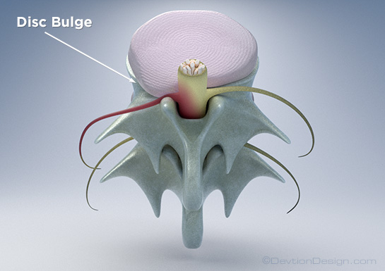 Herniated Disc