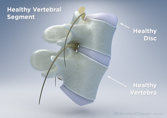 Herniated Disc
